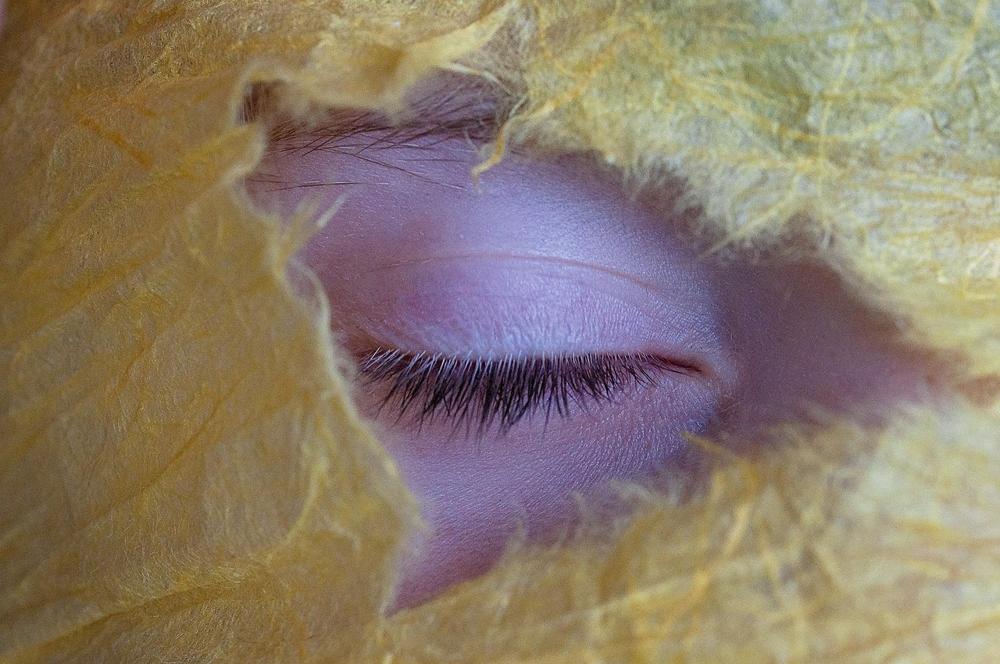 Drooping eyelid