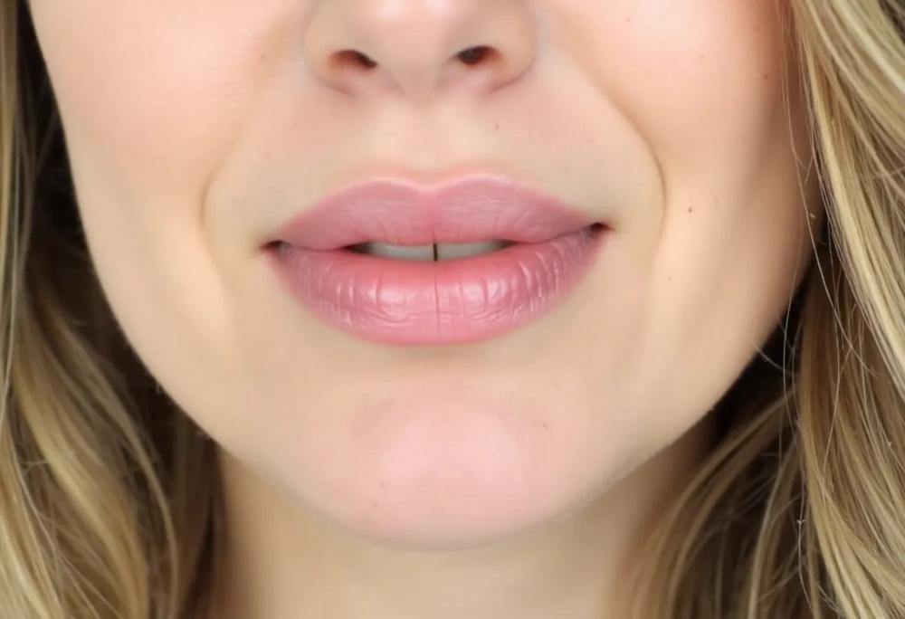 Lip enhancement