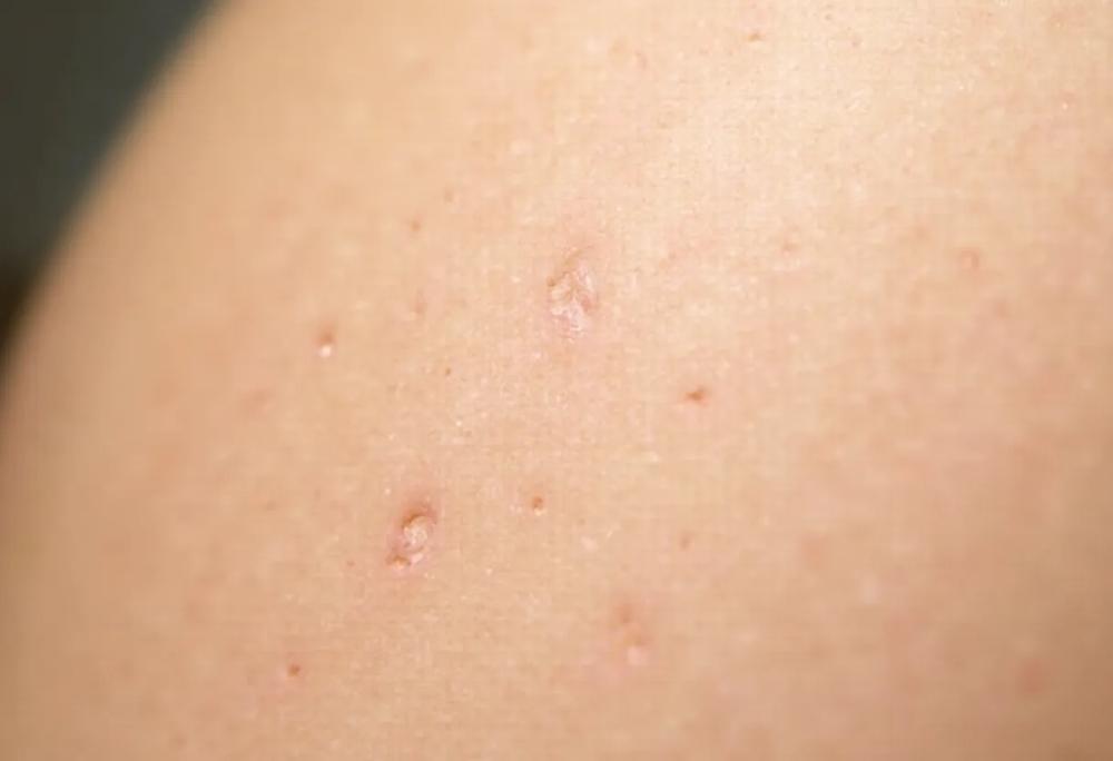 Skin texture