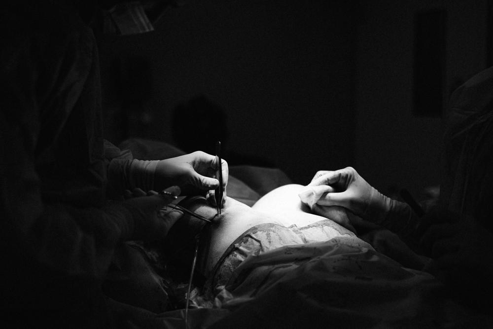 breast augmentation